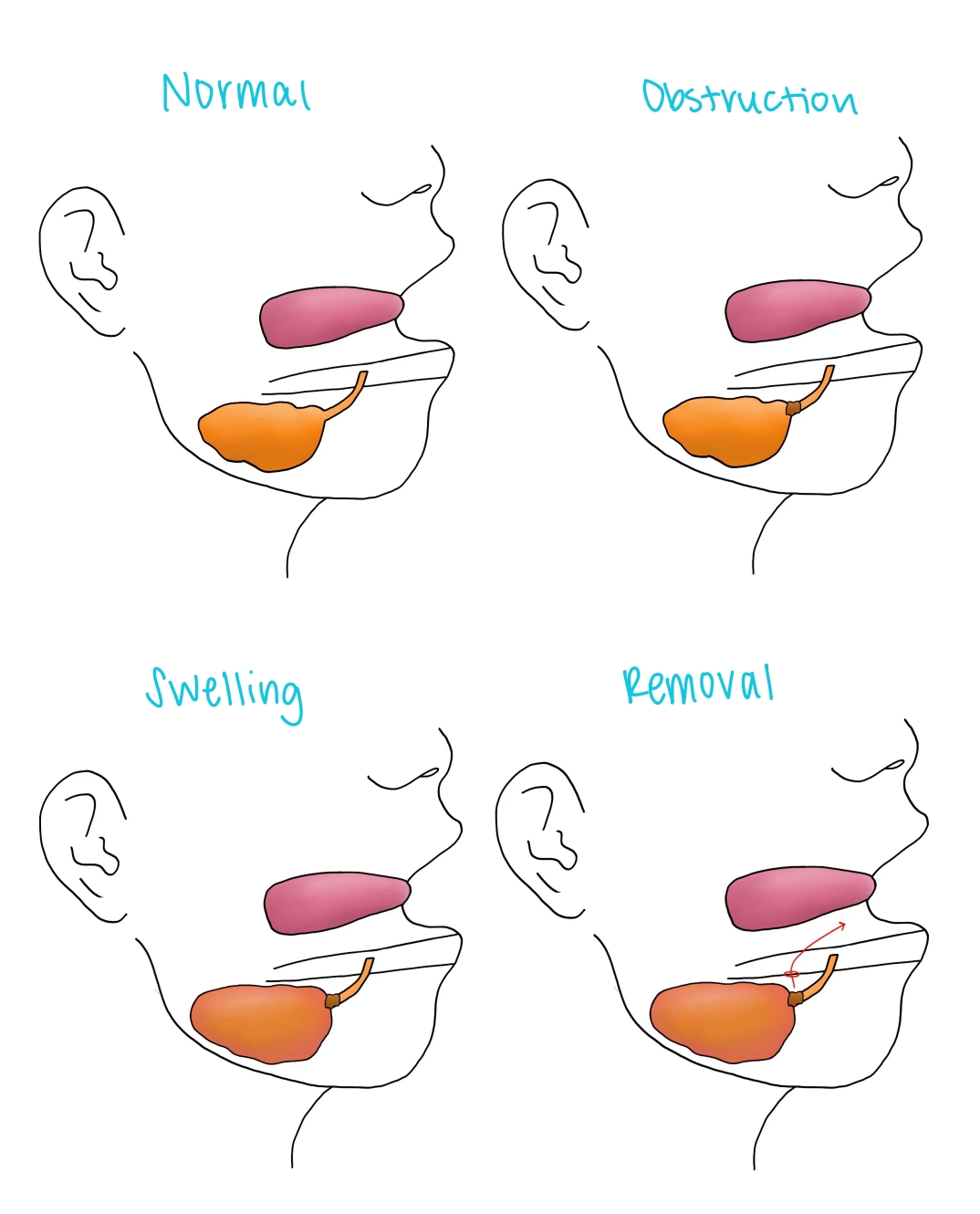 Fellow's four-panel profile drawing of a salivary gland showing normal, obstruction, swelling and stone removal