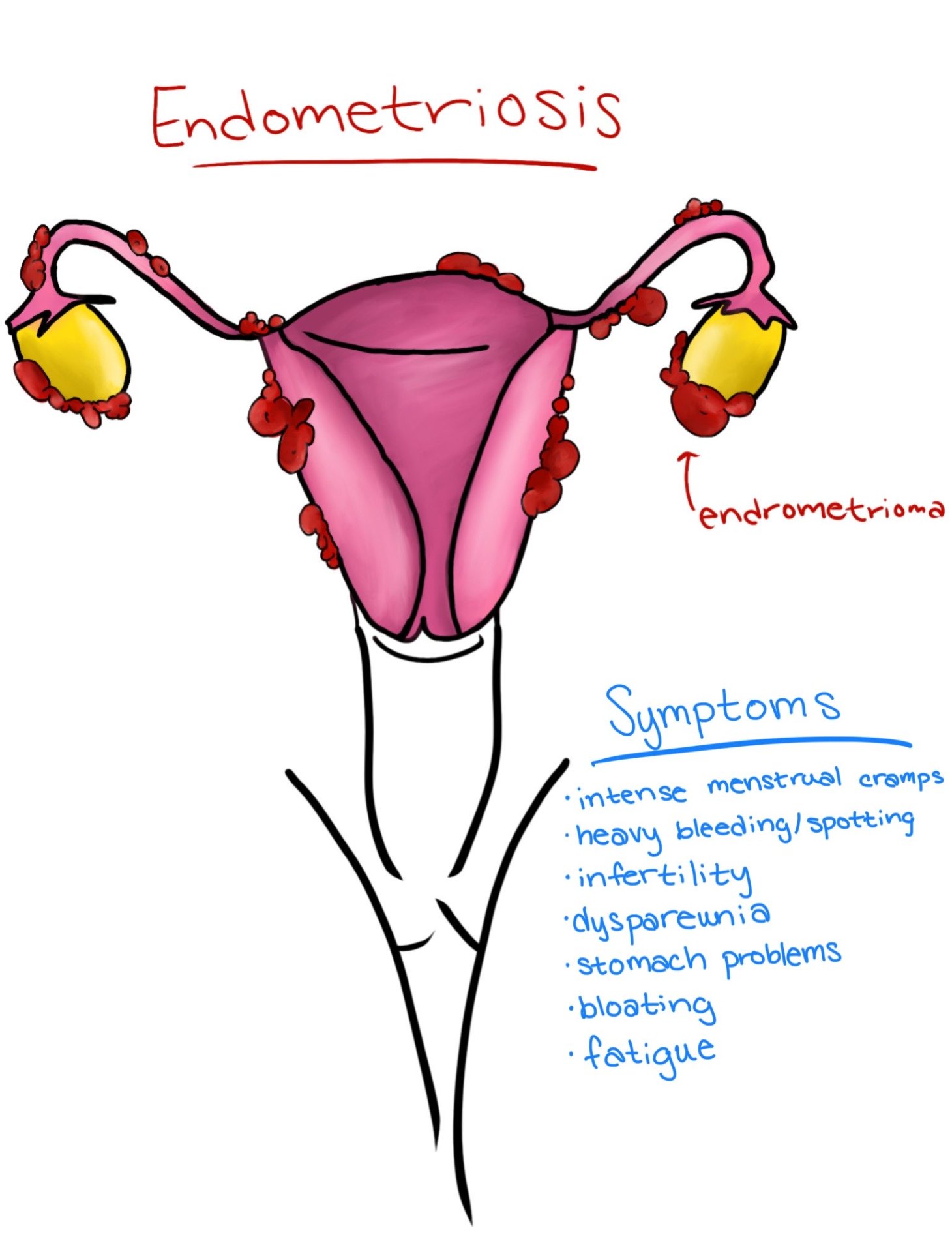 Fellow's labelled drawing of endometriosis with endometrioma and symptom list