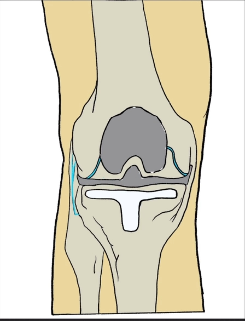 Fellow's drawing of a total knee replacement with implanted femoral and tibial components