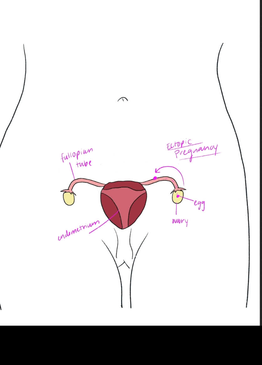 Fellow's drawing of an ectopic pregnancy with labelled fallopian tube, ovary, egg and endometrium