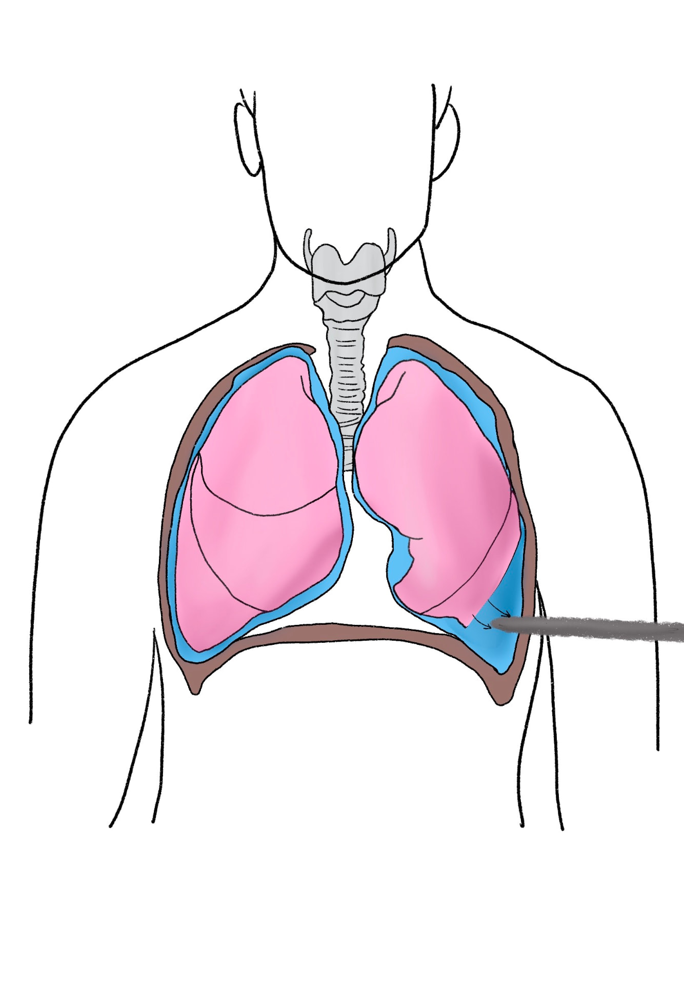 Fellow's drawing of the chest showing lungs, pleural space and a needle draining fluid