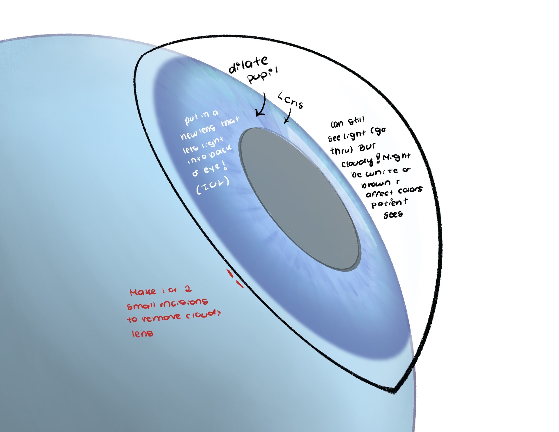 Fellow's annotated drawing of cataract surgery showing the cloudy lens, dilated pupil and lens replacement