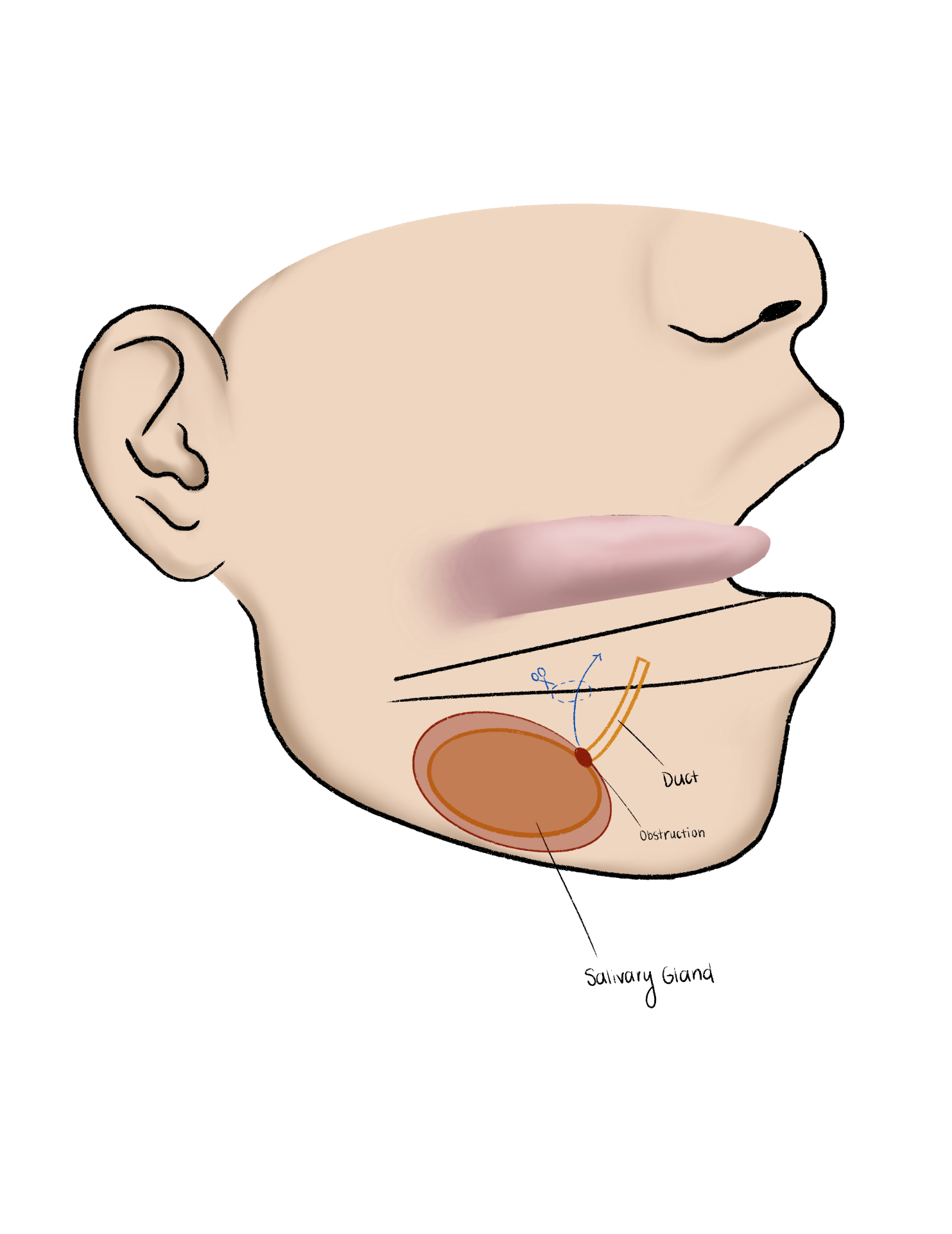Fellow's drawing of a salivary gland with an obstructed duct in profile view