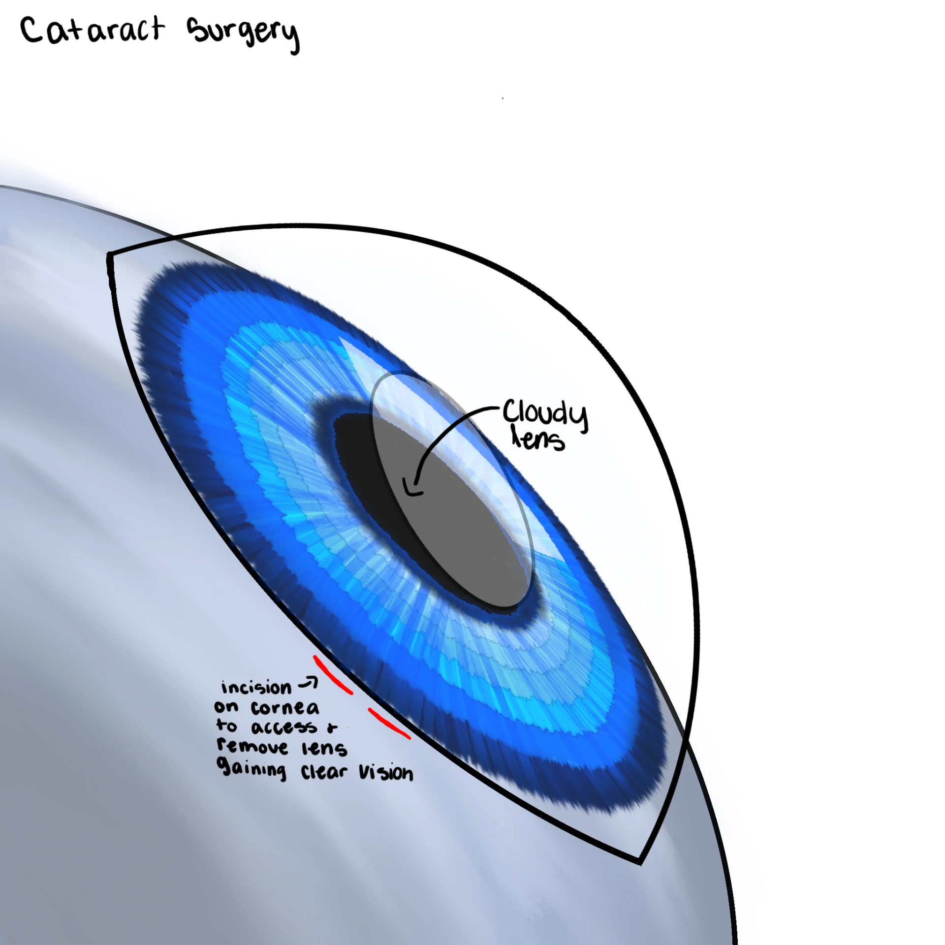 Fellow's close-up drawing of cataract surgery labelling the cloudy lens and the corneal incision used to remove it