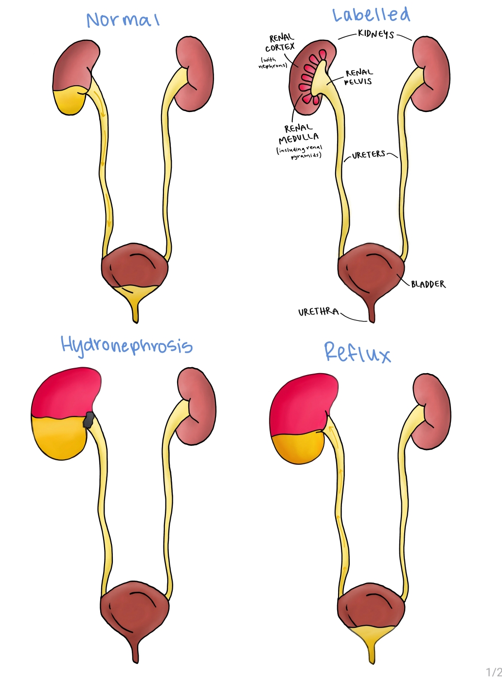 Fellow's four-panel drawing of the urinary tract showing normal anatomy, labelled kidney structures, hydronephrosis and reflux