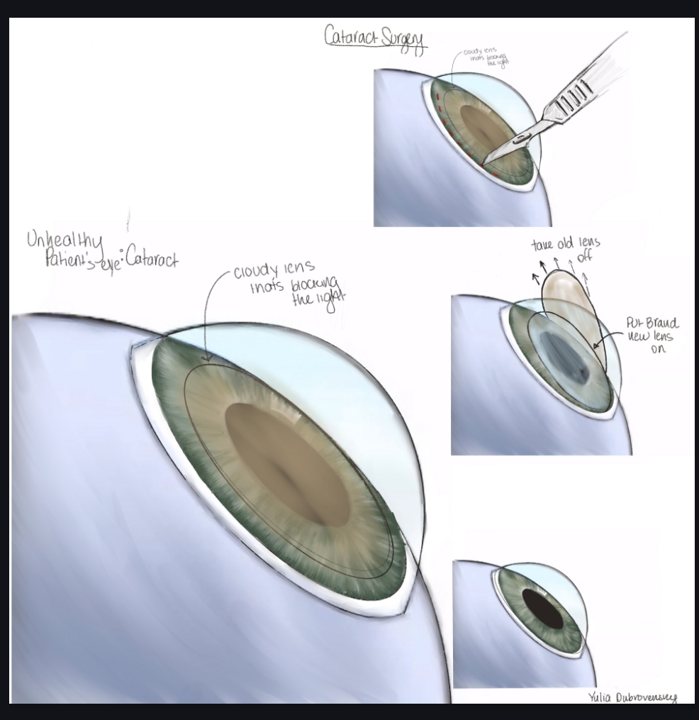 Fellow's multi-panel drawing of cataract surgery on an unhealthy eye with a cloudy lens