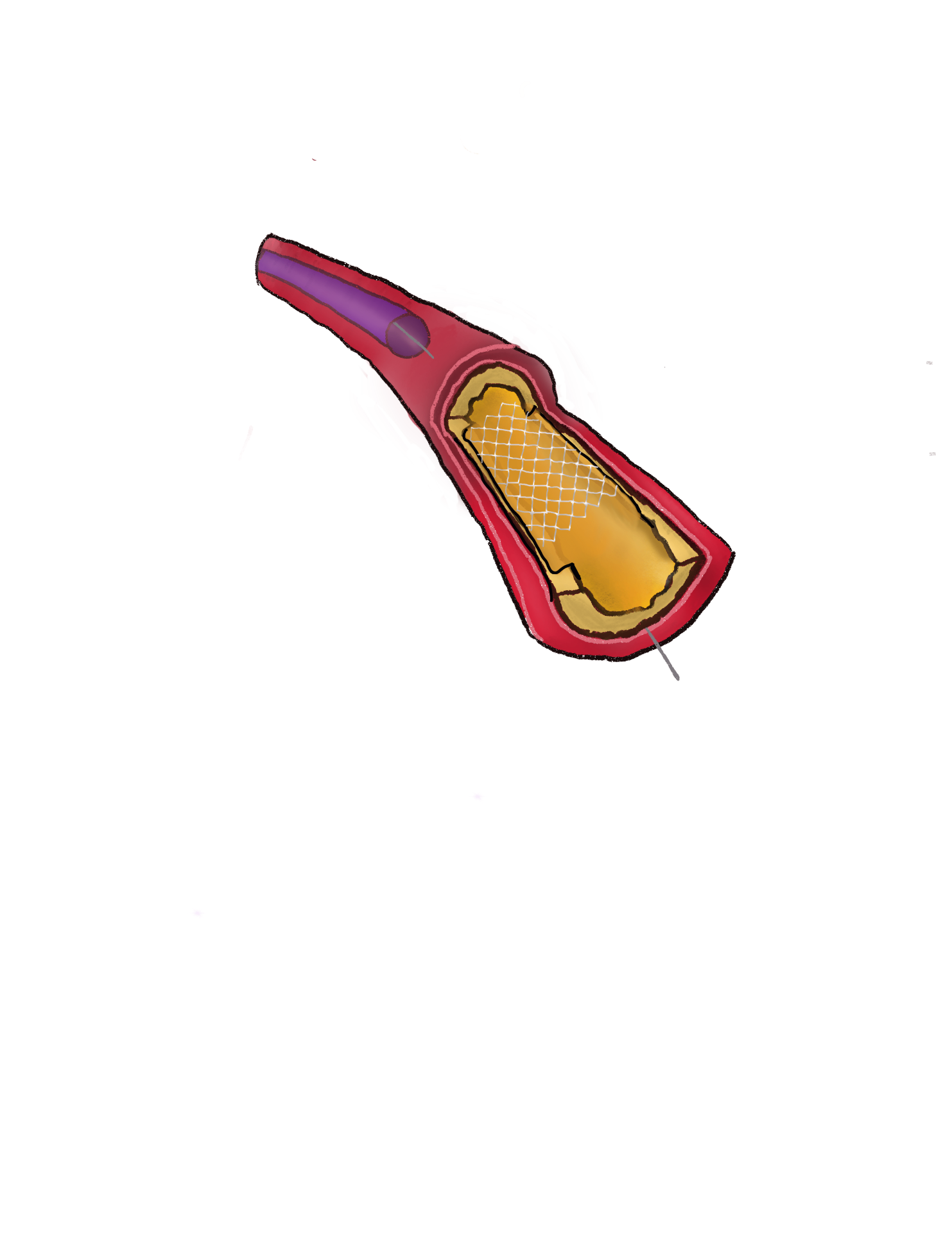 Fellow's drawing of a coronary artery with plaque and an implanted stent
