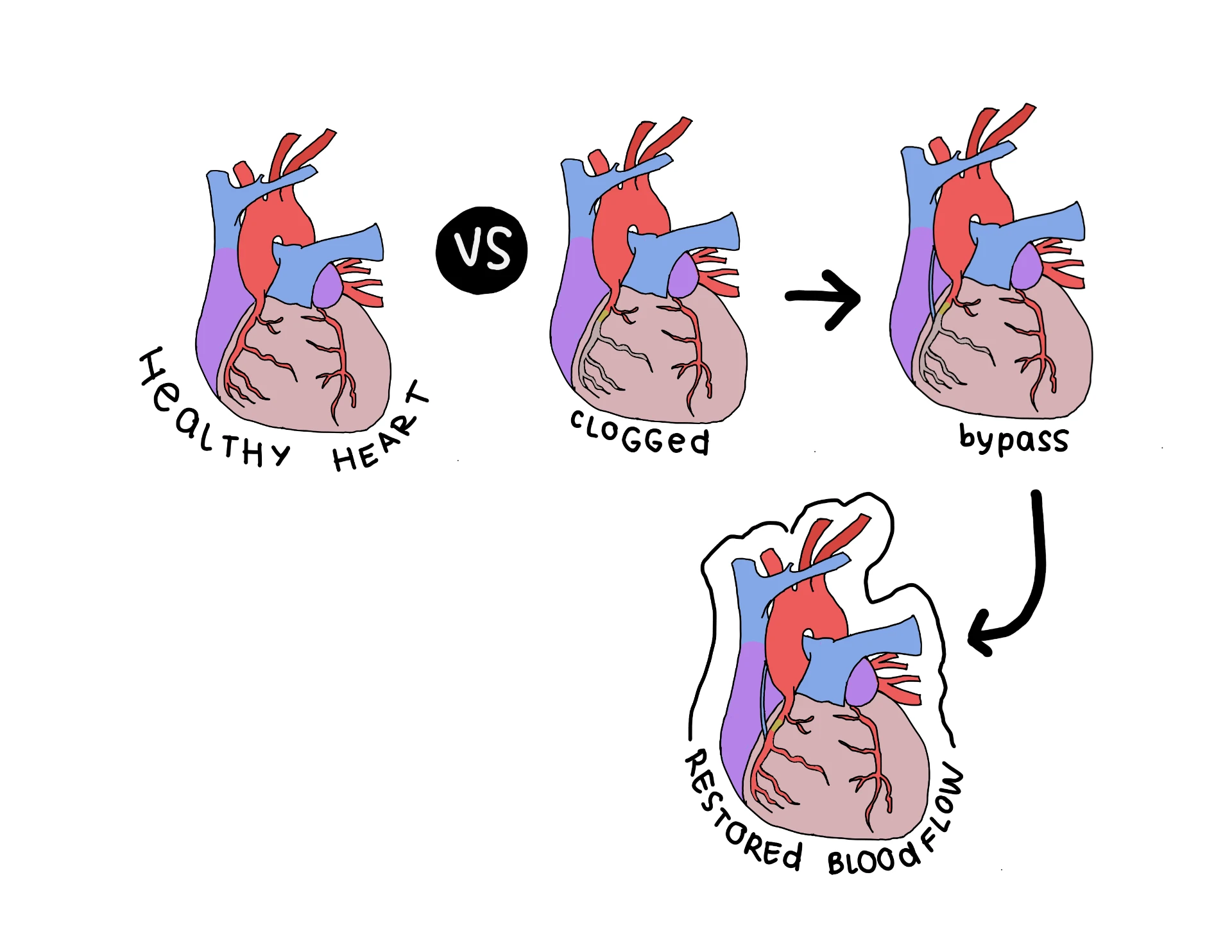 Fellow's drawing comparing a healthy heart, clogged coronary arteries, bypass graft and restored blood flow