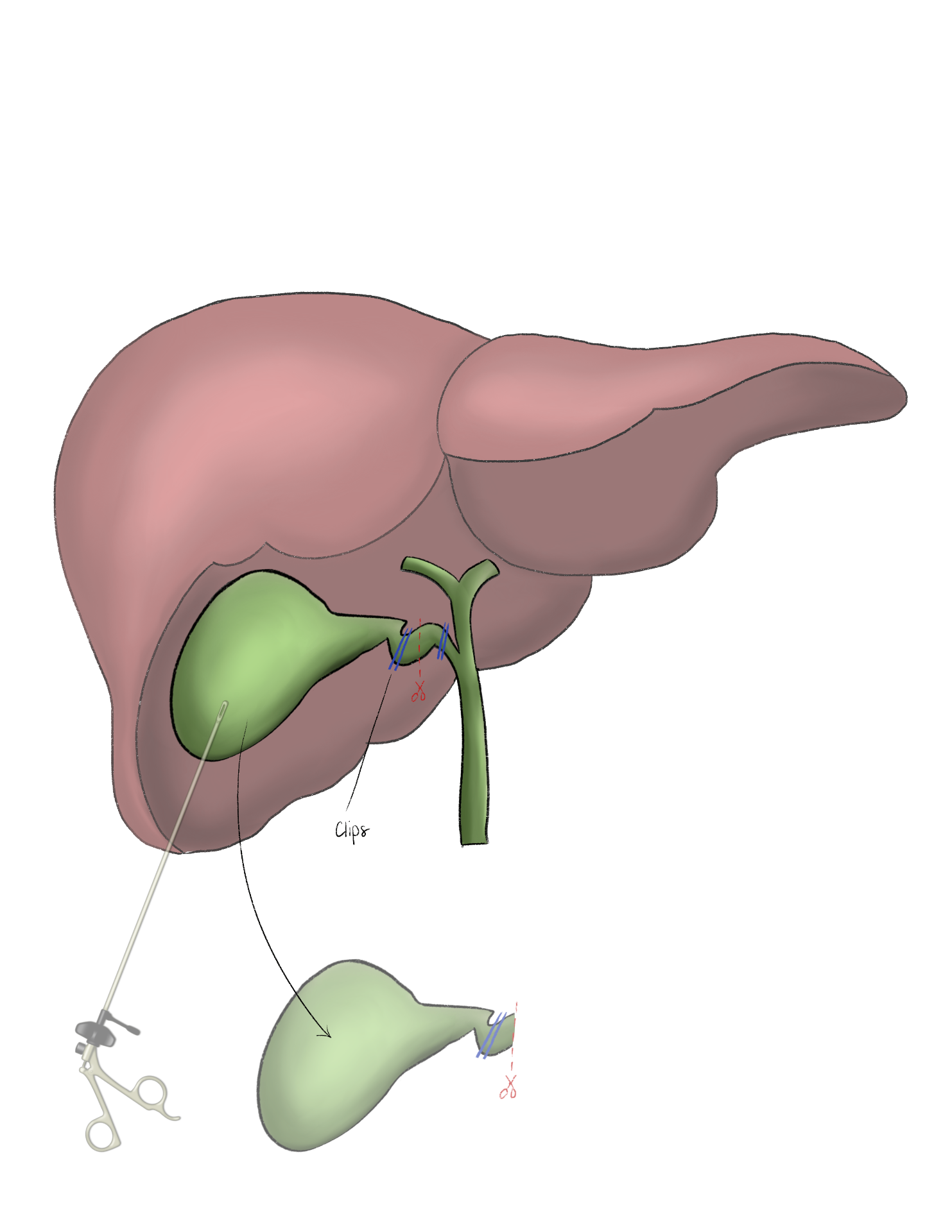 Fellow's drawing of a laparoscopic cholecystectomy with clips on the cystic duct