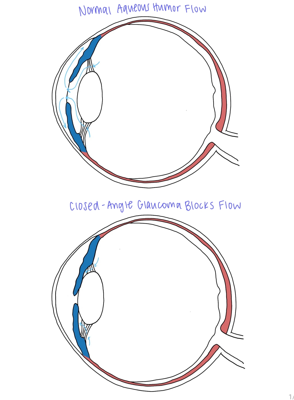 Fellow's drawing comparing normal aqueous humour flow in the eye with closed-angle glaucoma blocking flow