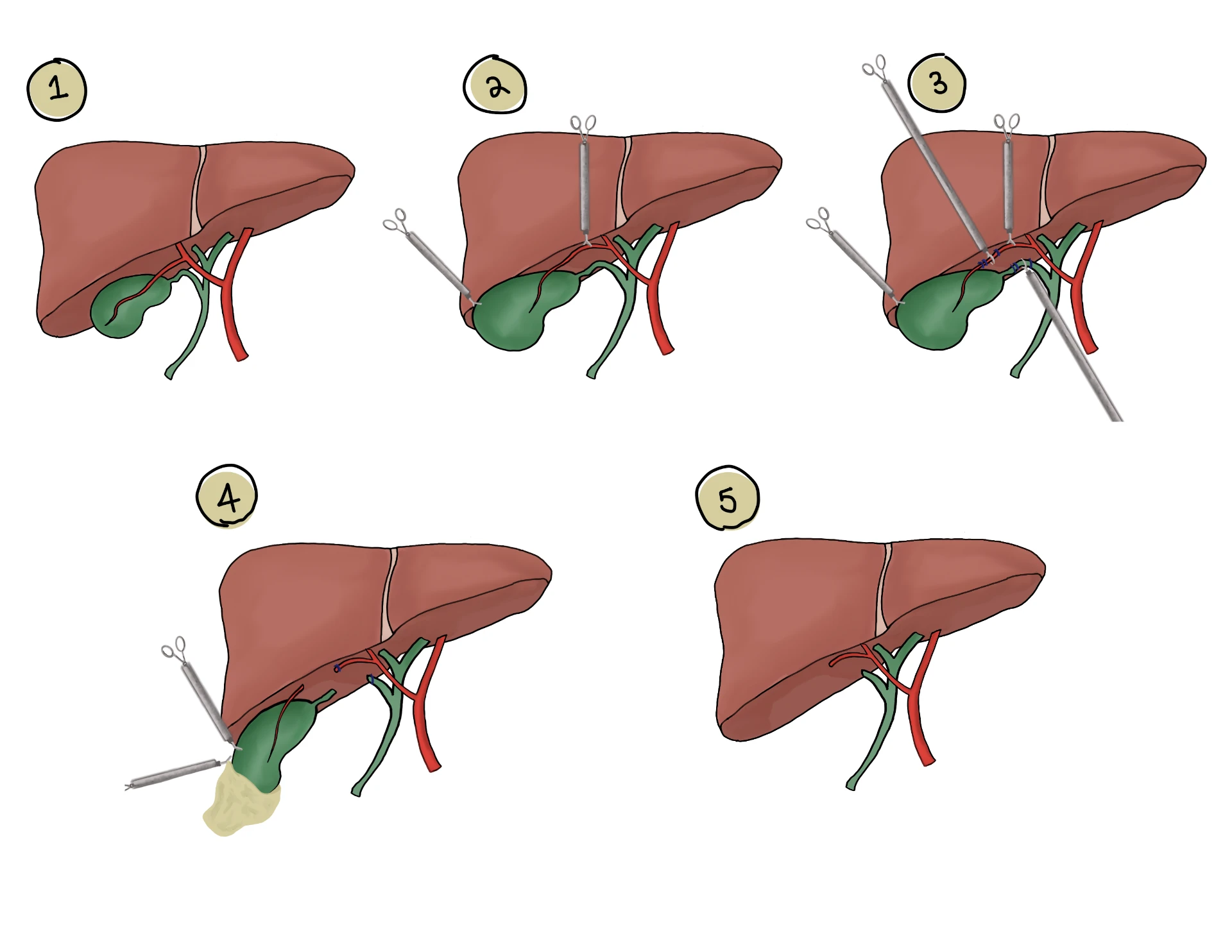 Fellow's five-step drawing of a laparoscopic cholecystectomy from clipping to gallbladder removal
