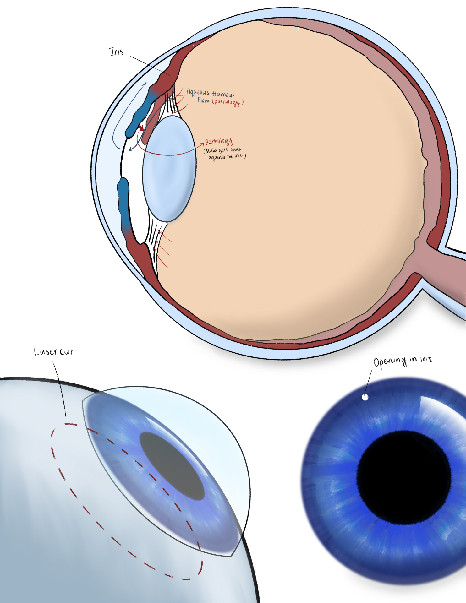 Fellow's drawing of aqueous humour flow in glaucoma and a laser iridotomy opening in the iris