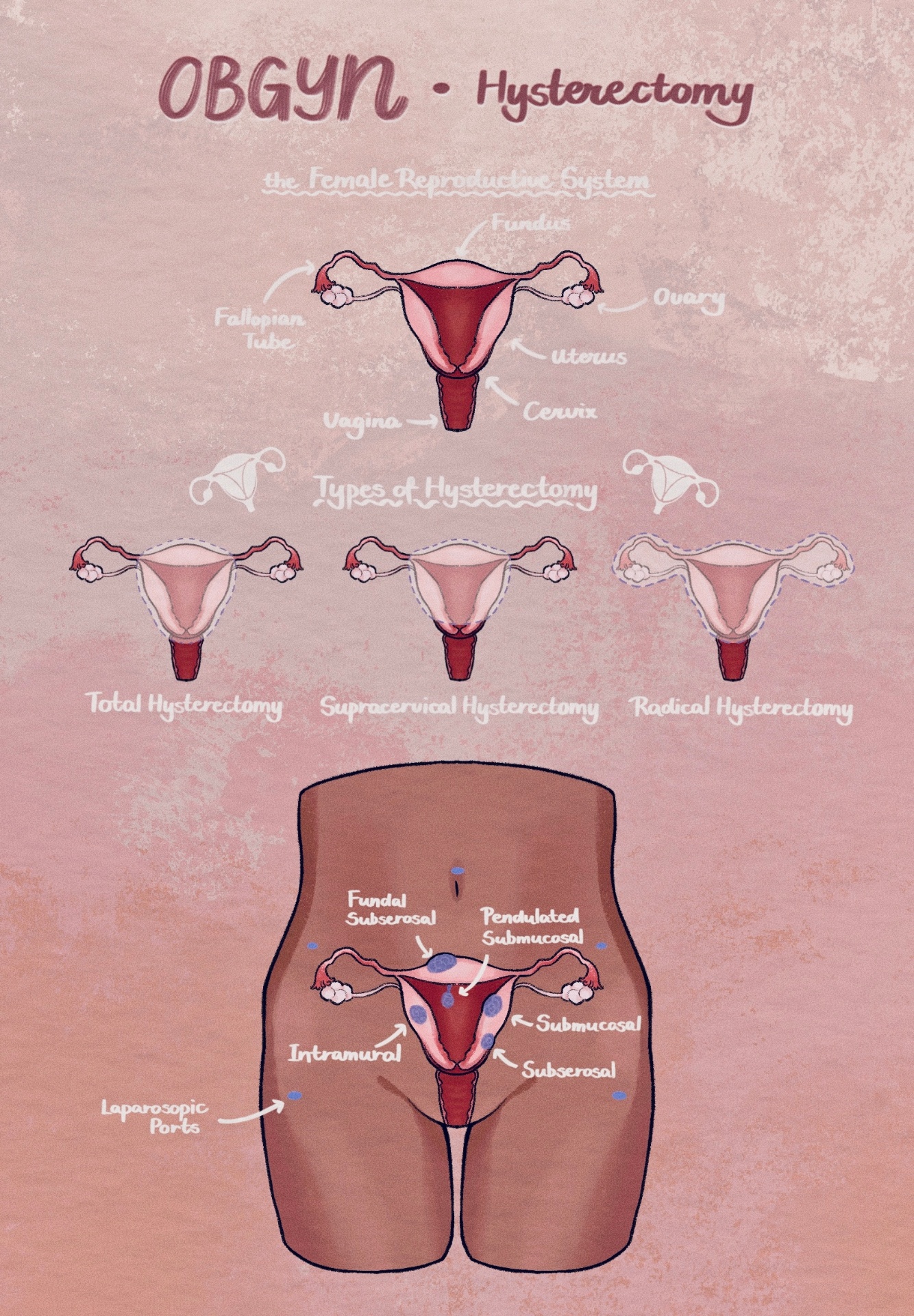 Fellow's illustrated guide to hysterectomy types and the female reproductive system