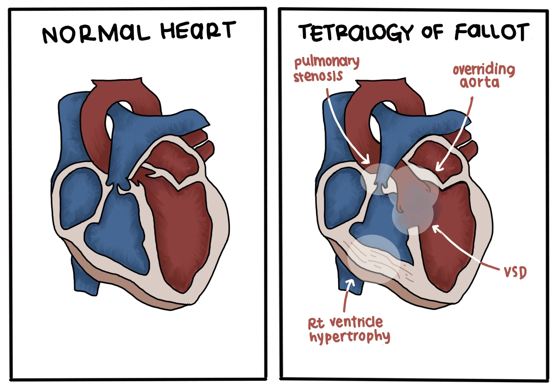 Fellow's side-by-side drawing of a normal heart and tetralogy of Fallot labelling pulmonary stenosis, overriding aorta, VSD and right ventricle hypertrophy