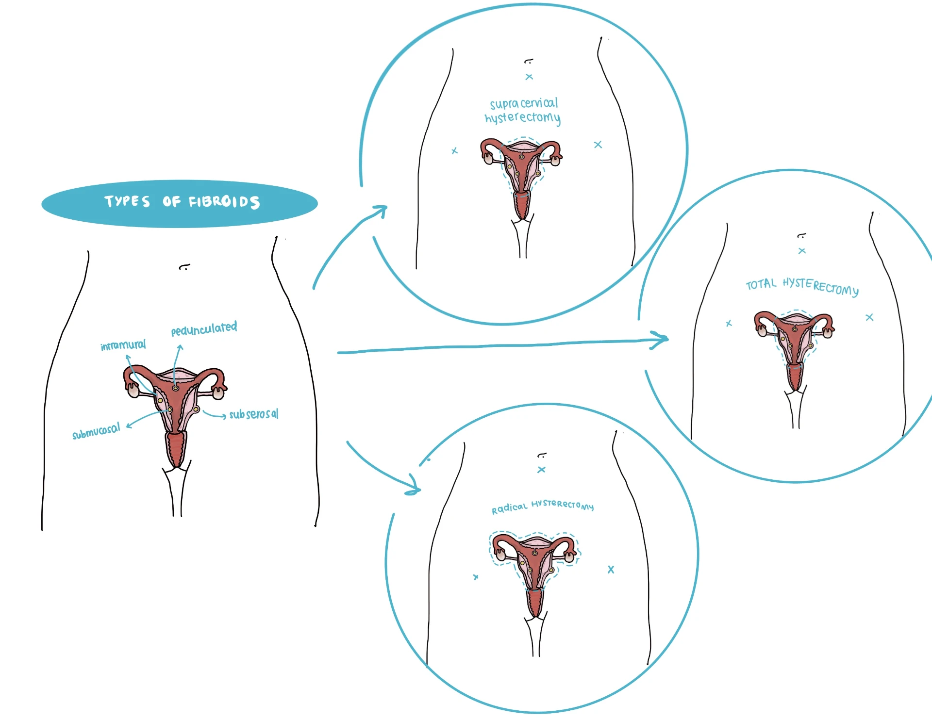 Fellow's diagram of fibroid types and supracervical, total and radical hysterectomy options